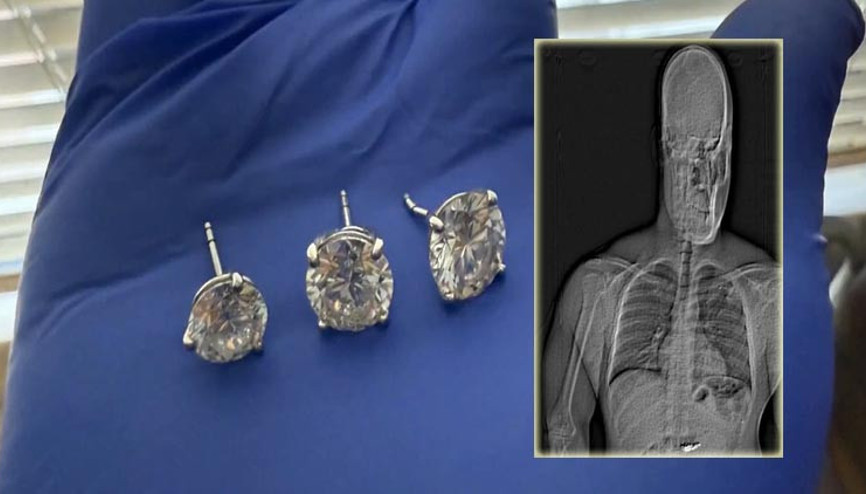 769 bin dolarlık küpeler midesinden çıkarıldı: Mağazaya iade edildi