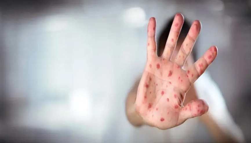 ABDde kızamık paniği: Vaka sayısı 500e yükseldi