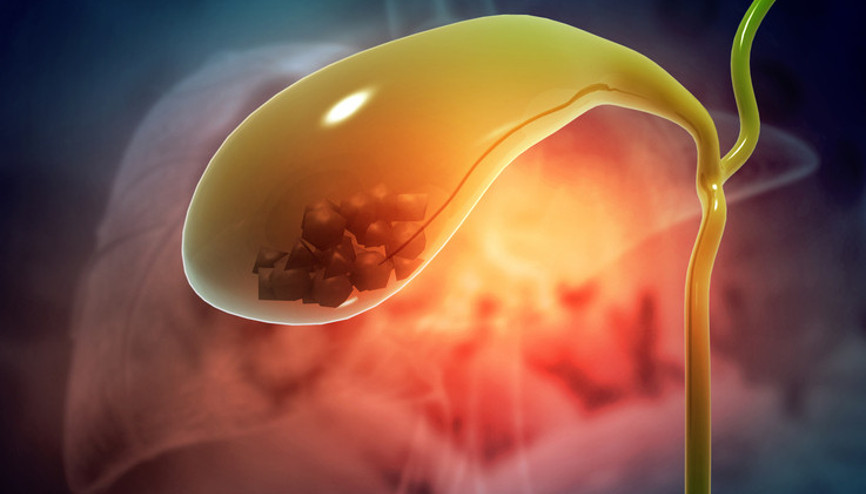 Ağrı yok, belirti yok, sinsice ilerliyor Safra kesesi taşı neden oluşur Ağrı yok, belirti yok, sinsice ilerliyor Safra kesesi taşı neden oluşur