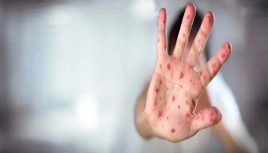 ABDde kızamık alarmı: Vaka sayısı 624e yükseldi