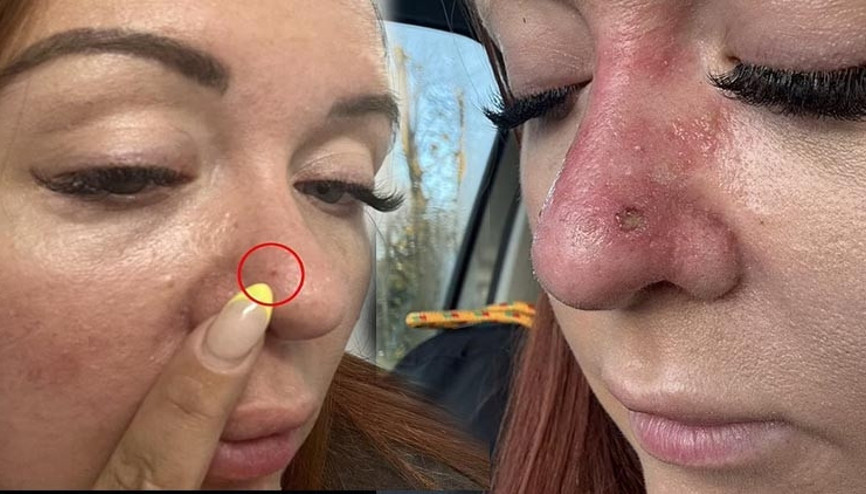 Sıradan bir sivilce sandı, ama hayatı altüst oldu Her yıl 2 binden fazla kişinin ölümüne yol açıyor Sıradan bir sivilce sandı, ama hayatı altüst oldu Her yıl 2 binden fazla kişinin ölümüne yol açıyor