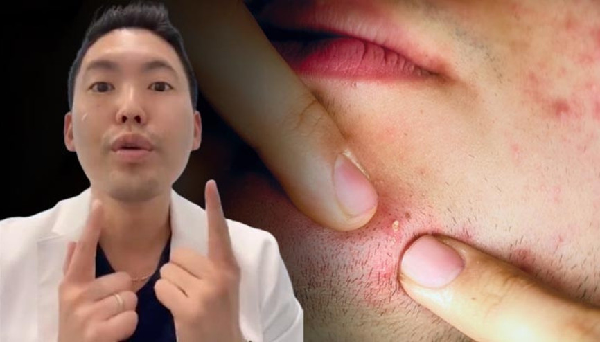 Uzmanı uyardı: Sivilcenizdeki gözden kaçan bu belirtiler kanser olabilir