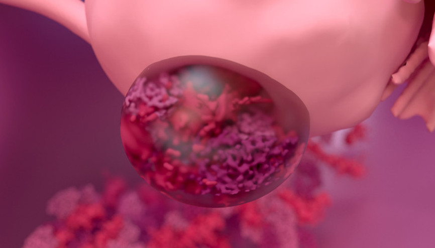 Miyomlar kansere dönüşebilir mi 10 soruda miyom gerçeği