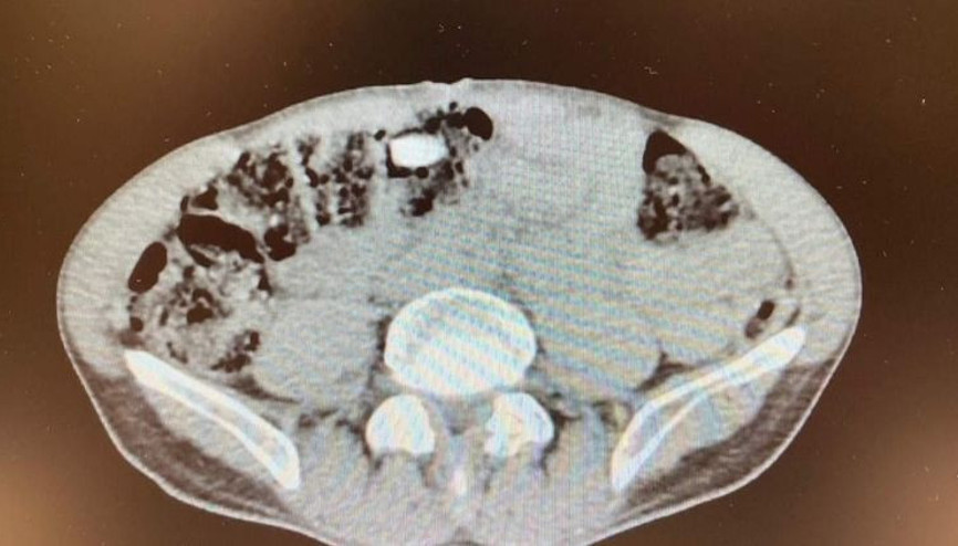 Midesinde uyuşturucu çıkan şüpheli tutuklandı