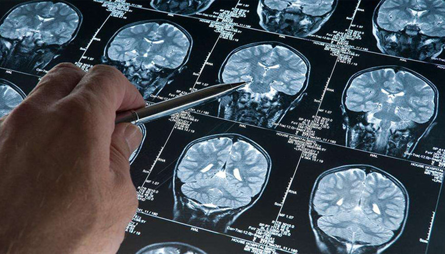 Alzheimerda yeni umut: Erken evrede teşhisi mümkün kılacak kan testi ABDde onaylandı Alzheimerda yeni umut: Erken evrede teşhisi mümkün kılacak kan testi ABDde onaylandı