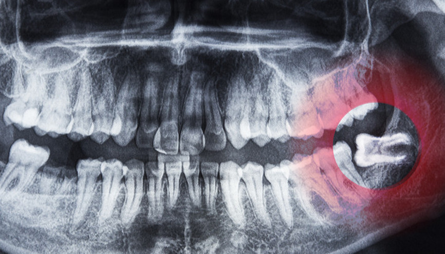 20 yaş dişleri neden gömülü kalır