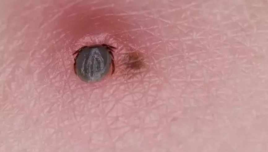 Kene ısırığı nasıl olur, belirtileri nelerdir Kene ısırığı izi nasıl görünür