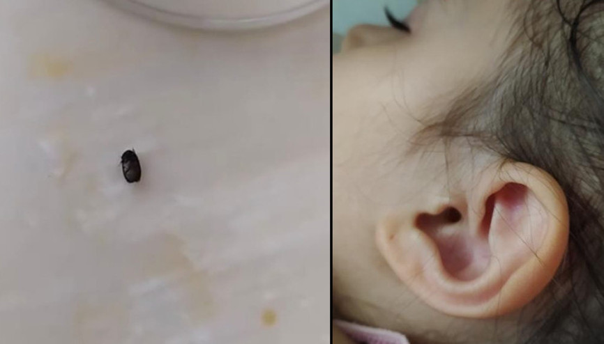 3 yaşındaki çocuğun kulağına kene yapıştı İzmitte kene alarmı