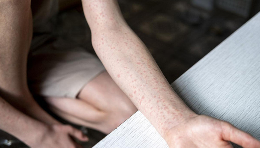 ABDde kızamık salgını: Vakalar son 33 yılın en yüksek seviyesinde