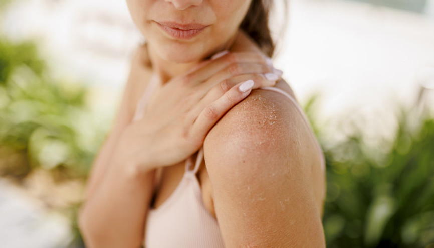 Bu hastalıkları olanlarda güneş faydadan çok zarar veriyor Nelere dikkat edilmeli