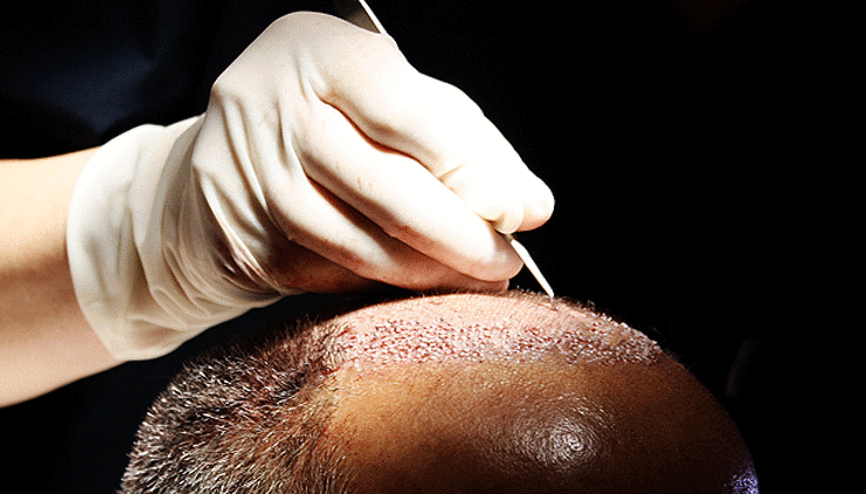 Saç ekiminin ardından fenalaşan İngiliz hasta hayatını kaybetti