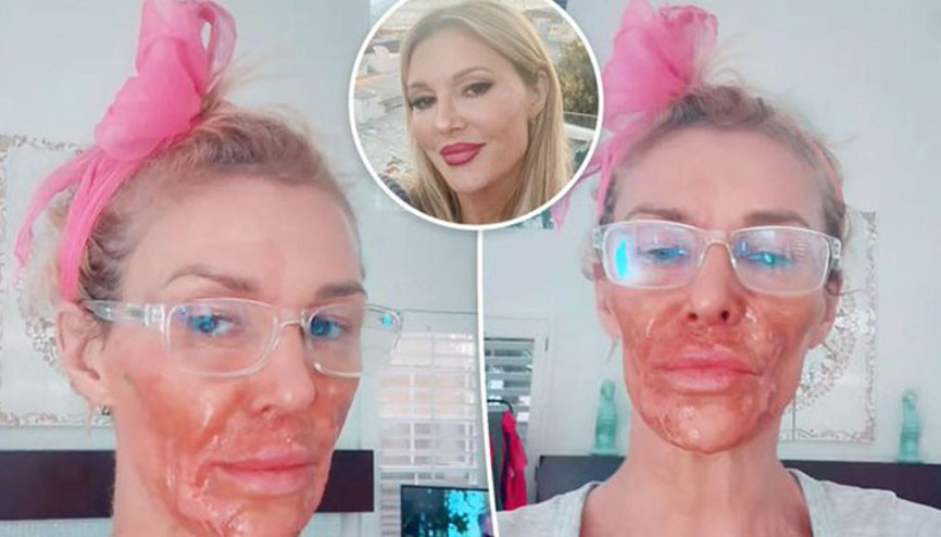 ‘Yüzüm eriyip gitti, perişanım’ diyordu… Hem parası tükendi hem de kendi kendine tedavi olmaya çalışınca suratı kavruldu