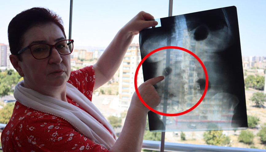 Hastanede hayatının şokunu yaşadı 22 yıldır karnında: Canlı bomba gibi geziyorum Hastanede hayatının şokunu yaşadı 22 yıldır karnında: Canlı bomba gibi geziyorum