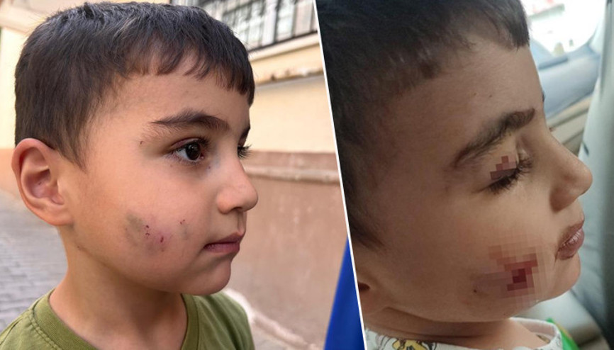 Ankarada korkunç olay Evinde uyuyan çocuğu lağım faresi ısırdı