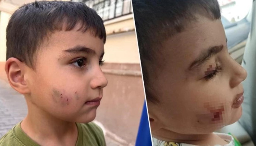 Ankara’da evde uyuyan küçük çocuğu lağım faresi ısırdı