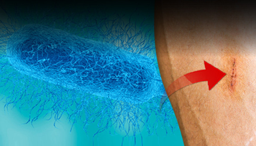 Sinsi tehlike: Et yiyen bakteri can alıyor, vaka sayıları arttı Küçük bir çizik neredeyse hayatına mâl olacaktı