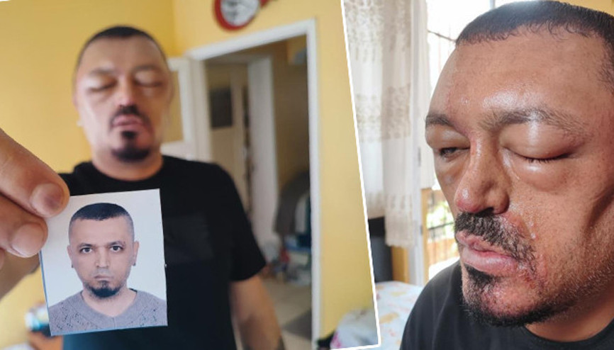 Berberi önerdi internetten satın aldı 48 saat sonra hayatı kabusa döndü | Gözlerimi kaybedeceğim diye çok korktum