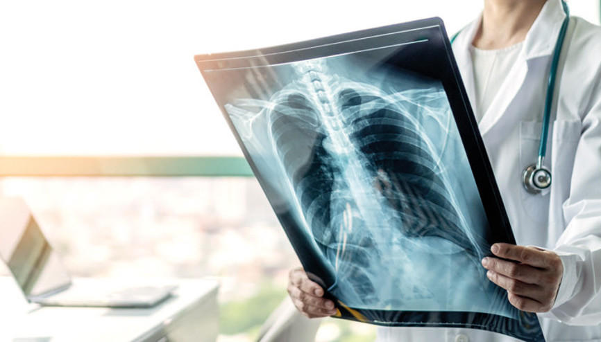 Akciğer kanserinin maliyeti 129 milyar TL