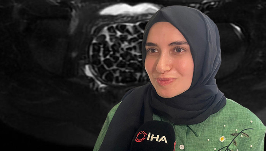 Doktorları bile şaşkına çeviren vaka Genç kadının vücudundan 287 adet çıktı... Literatürde çok nadir görülüyor