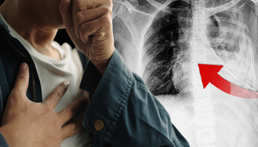 Gençliğinize güvenmeyin Öksürürken kaburgalarınız kırılabilir