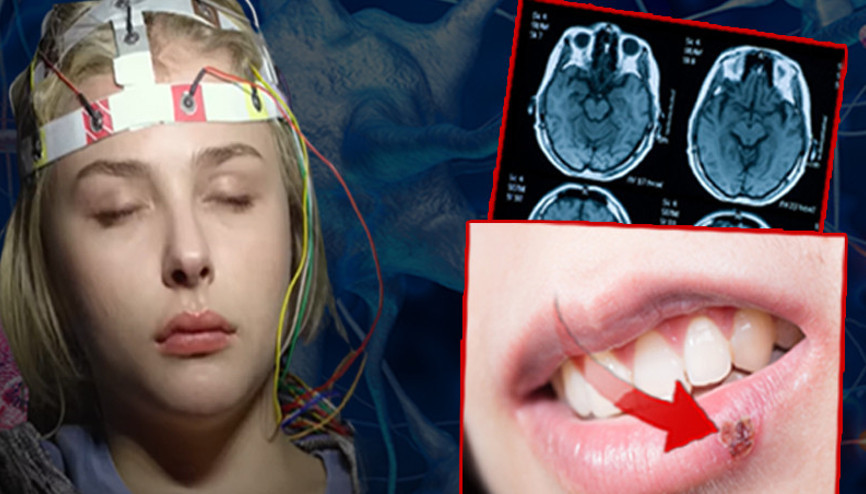 Beyinde uçuk mu olur Uykuya geçip yıllarca sessiz kalabiliyor Her uçuk çıkaranda aynı risk var mı