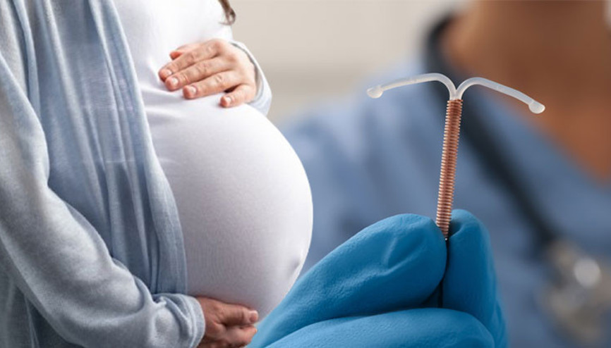 Tüplerini bağlatan kadın hamile kaldı Dünyanın başka yerlerinde ise bebekler ellerinde spiral ile doğuyor... ‘En güvenilir’ olduğu söylenen korunma yöntemleri neden korumuyor