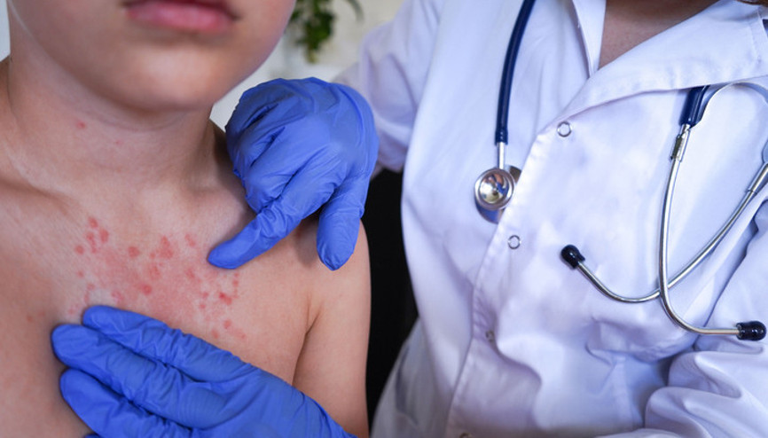 Alerji sanmıştı, gerçek çok farklı çıktı: ‘Tüm ailem etkilendi | Herkes risk altında