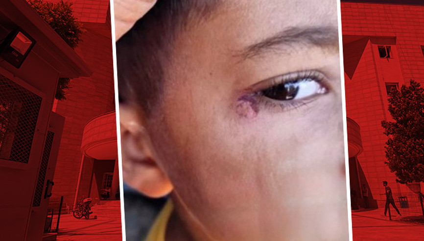 Okulun temizlik görevlisi, 7 yaşındaki çocuğun yüzünde sigara söndürdü