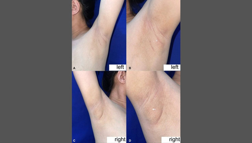 Filipinli kadının koltukaltından süt geldi: Nadir görülen durumun nedeni ne