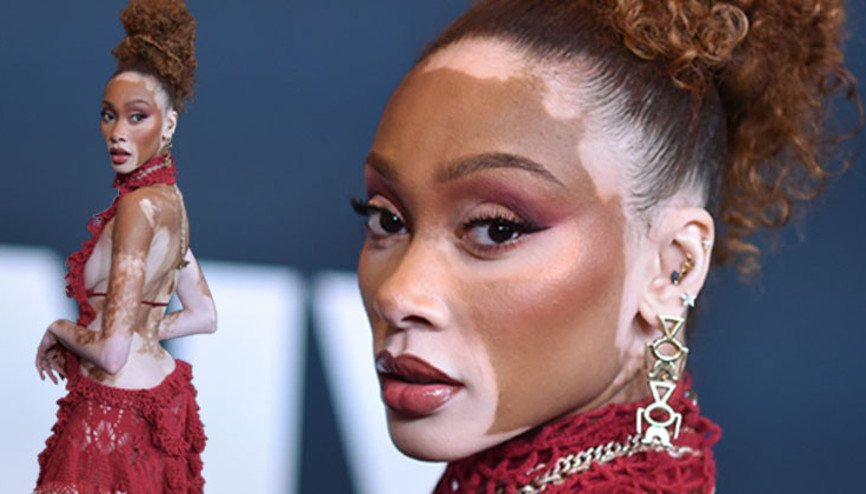 Alay edilen hastalığı onun şansı oldu... Şimdi büyük bir şöhreti ve bir sürü parası var... Yine kırmızı halının yıldızı oldu