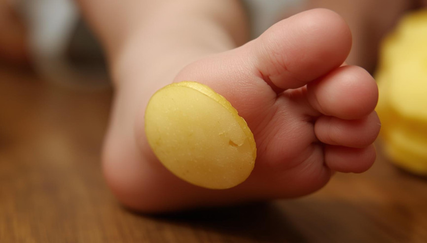 Çiğ patates dilimleri soğuk algınlığını iyileştirir mi