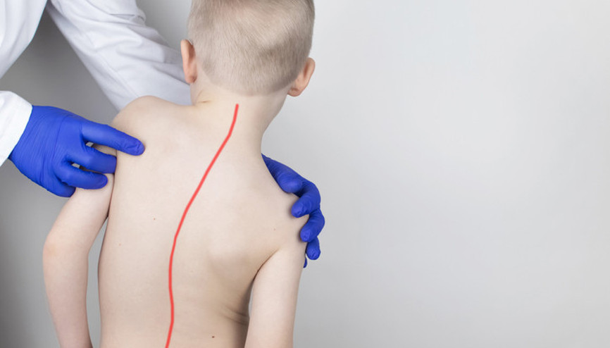 Çok önemsenmiyor ama aslında bir halk sağlığı sorunu... Skolyoz vakaları özellikle çocuklarda ve ergenlerde artıyor