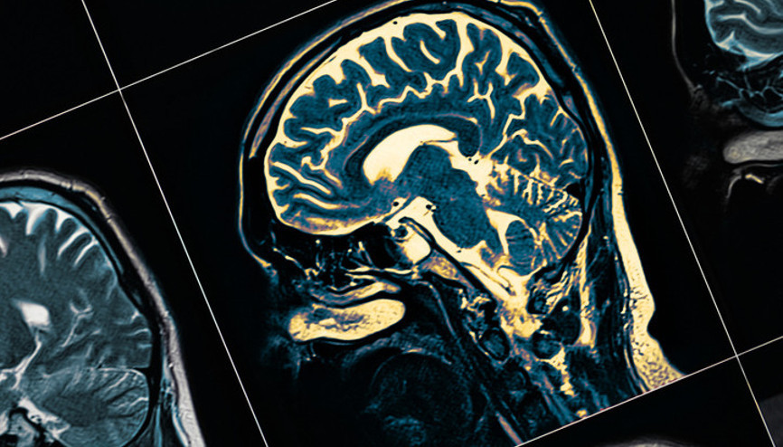10 klinik çalışmanın ortak bulgusunu açıkladı: Bu diyet Alzheimer’da beyin fonksiyonlarını olumlu etkiliyor