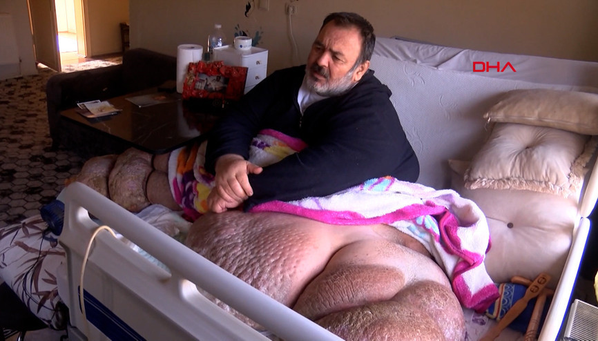 5 yıldır evden çıkamayan 300 kiloya ulaşan fil hastasının hayali; eşiyle kol kola caddede gezmek