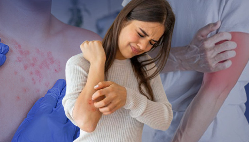 Acil servislerde yoğunluk arttı: Sessizce yükselen uyuz tehlikesi ‘Genellikle bu iki şikâyetle başvuruyorlar’ | NASIL ÖNLEM ALINMALI