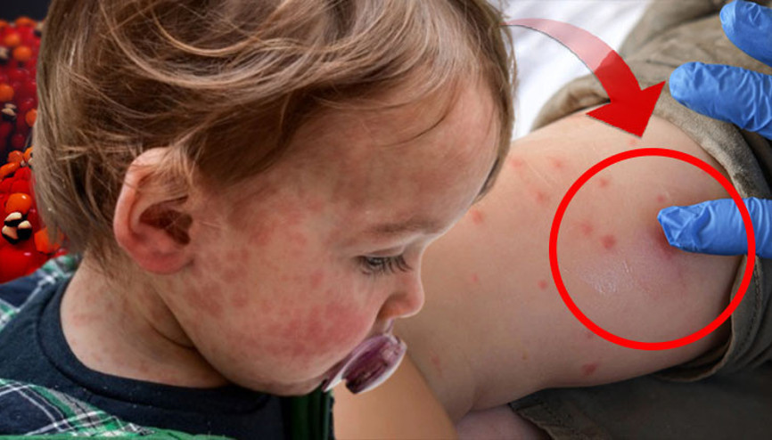 Kızamığın bilinmeyen yüzü: Yıllar sonra ortaya çıkıyor ve ölüme yol açıyor ‘Tedavisi yok, ölüm oranı yüzde 95’