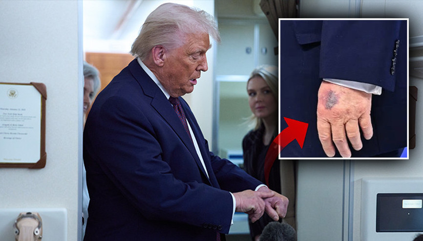 Trump elindeki morluğun sebebini açıkladı