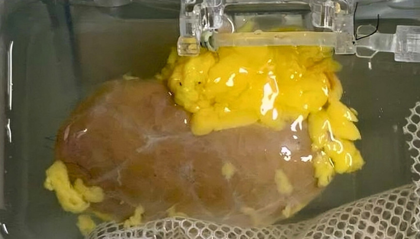 Böbrek naklinde uyuşma sorunu ortadan kalkabilir