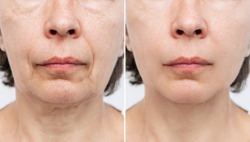 Botoks ve dolguya alternatif: Sıvı yüz germe Yüzünüzü doğal yolla canlandırmanın yolu