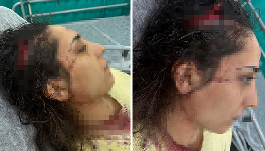 Bakkala giden genç kadın sokak köpeklerinin saldırısına uğradı Bakkala giden genç kadın sokak köpeklerinin saldırısına uğradı