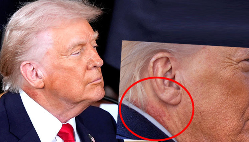 Trump’ın boynuna ne oldu Kanser tedavisi mi görüyor