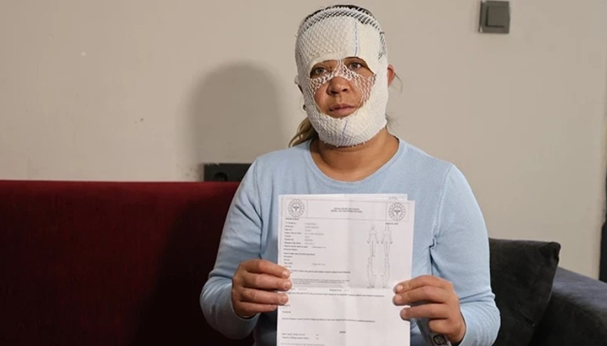 Güzelleşmek uğruna gittiği merkezde yüzü yandı