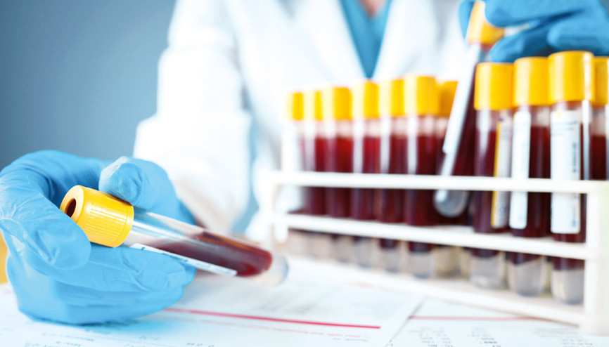 Alzheimer’da kan testi umudu