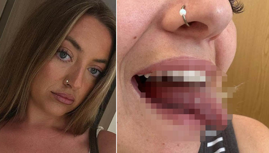 Ağız yarası sanıldı, kanser çıktı 25 yaşındaki genç kadının dili için kritik ameliyat kararı