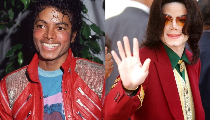 Michael Jackson’ın görüntüsünü değiştiren hastalık yeniden gündemde: Vitiligo nedir, kimleri etkiler