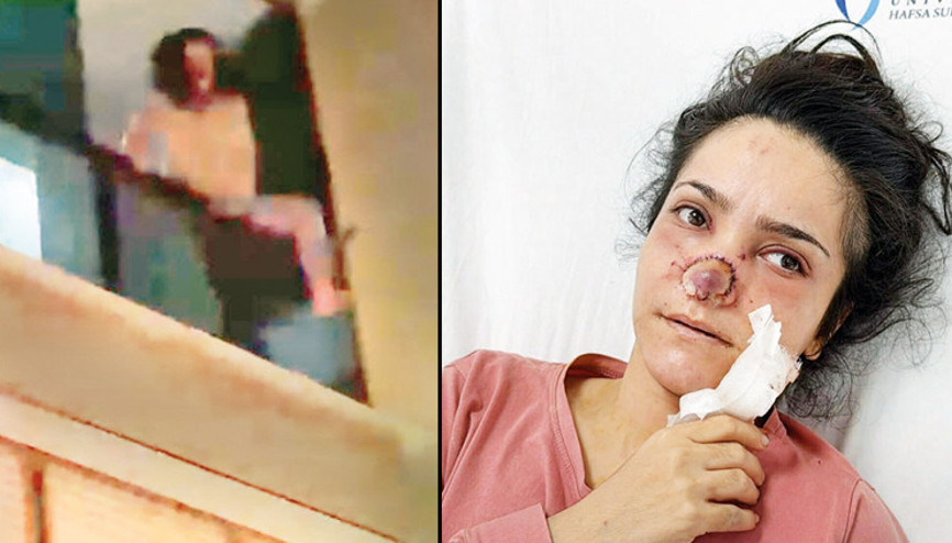 Burnu ısırılıp koparılan İmran: Acıdan atlamayı düşündüm Burnu ısırılıp koparılan İmran: Acıdan atlamayı düşündüm