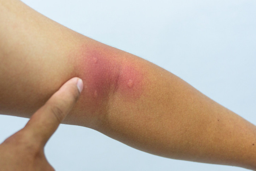 Neden böcekler bazı insanları daha çok ısırır Uzun boylu erkekler daha çok risk altında...